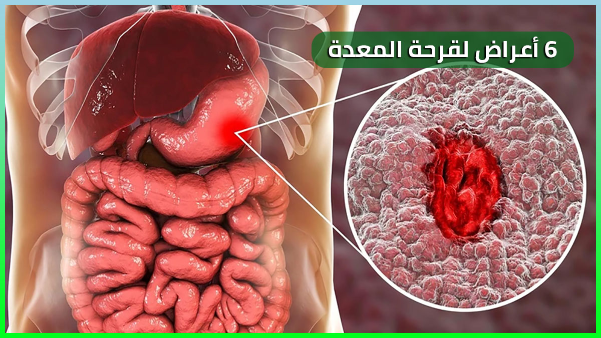 6 أعراض لقرحة المعدة