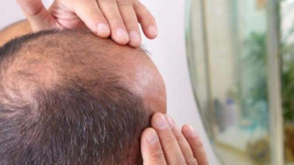 العلاج لتساقط الشعر